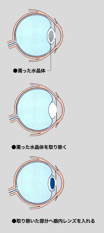 白内障の治療